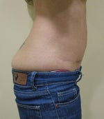 8 weeks after, side view